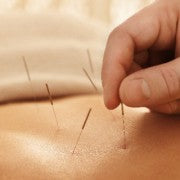 Close-up of an acupuncture treatment with thin needles inserted into the skin, representing verified acupuncturists and alternative medicine professionals for healthcare contact lists